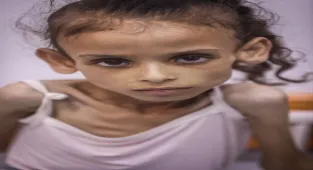 İsrail’in kıtlığa sürüklediği Gazze’de 9 yaşındaki Meryem, 25 kilodan 10 kiloya düştü