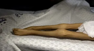 İsrail'in yol açtığı kıtlık nedeniyle Gazze'de 5 yaşındaki çocuk açlıktan yaşamını yitirdi