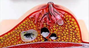 Araştırma: Meme kanseri taramasında yapay zeka kullanımı geç teşhisleri yüzde 12 azaltıyor